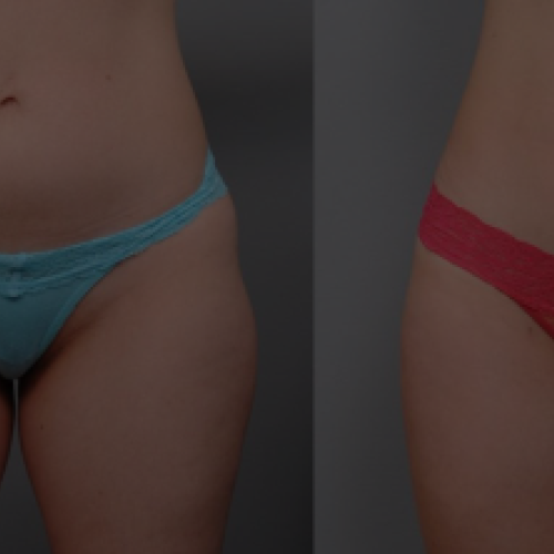 Liposucción Láser Foto antes/después